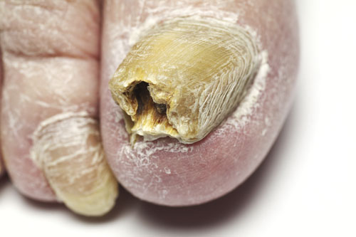 thickening, crumbling and peeling from toenail fungus