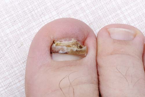 toenail fungus picture 4