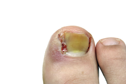 dangers of toenail fungus