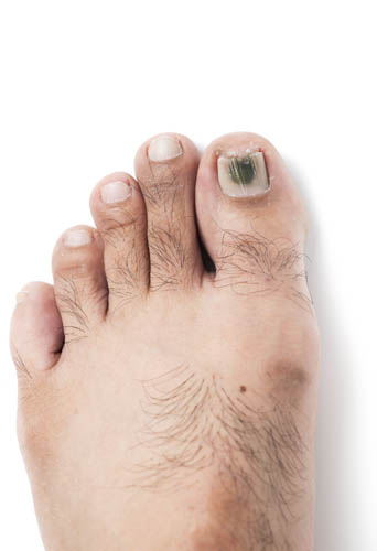 discoloration from toenail fungus